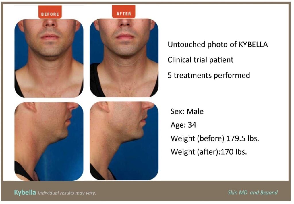 2 before and after photos showing disappearance of double chin and statistics about the man