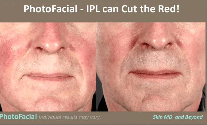 get rid of red face veins