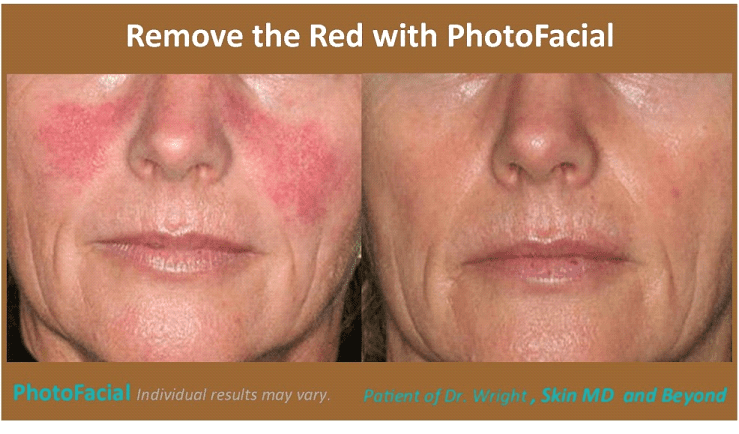 Before & After image of Red Face Treatments Frisco TX