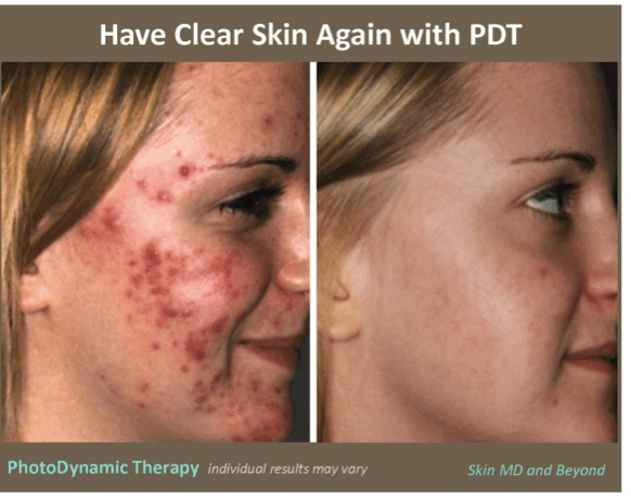 Photodynamic Therapy Plano, TX | PDT Frisco, TX | Acne ...