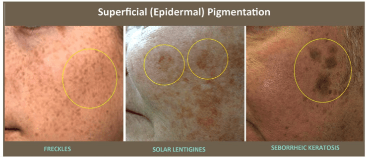 Brown Spots Treatment  McLean & Potomac Dermatology