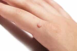 A woman's hand has a wart on the pinky finger.