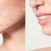 Close-up of woman's face after tackling her acne breakouts.