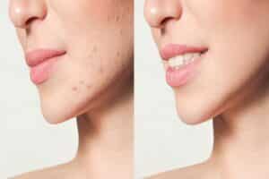 Young woman's acne breakouts diminish over time with treatment