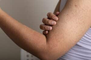 A woman shows her arm with keratosis pilaris.
