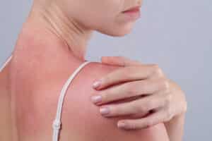 Woman with sunburn is at an increased risk for skin cancer later