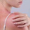 Woman with sunburn is at an increased risk for skin cancer later
