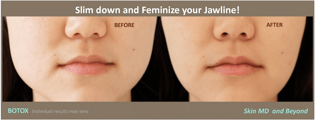 Before and after square jaw lines Frisco