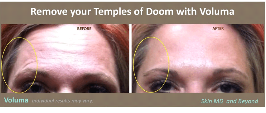 Before and after Voluma Plano TX