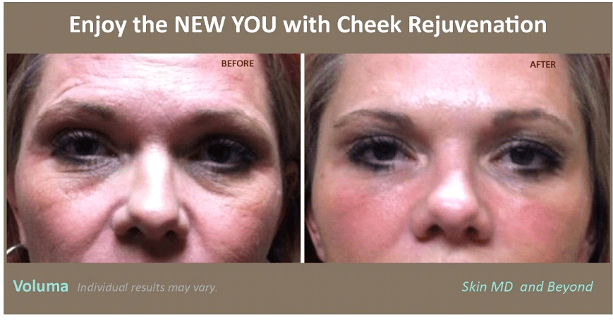 Before and after Voluma Treatment Plano TX