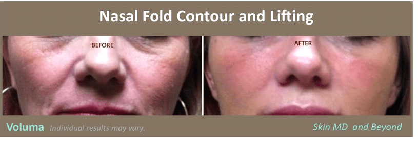Before and after Voluma Treatment Frisco TX