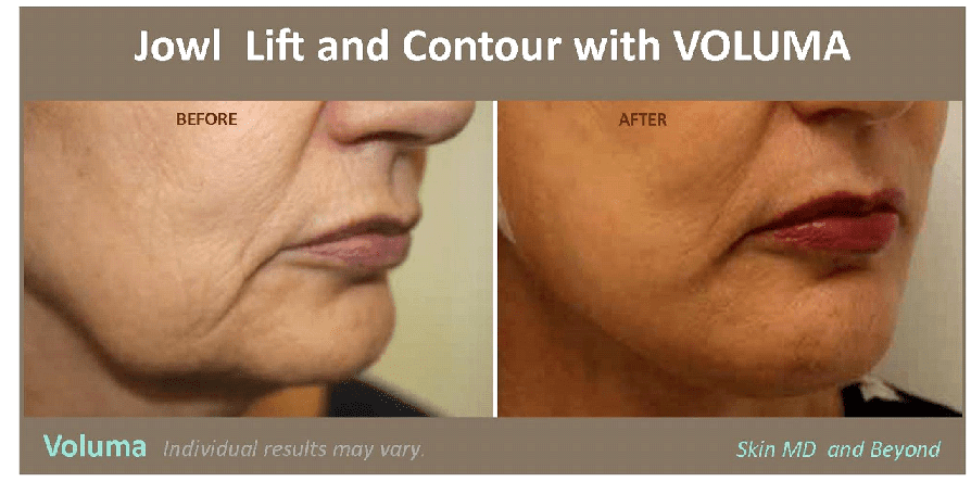 Before and after Voluma Frisco TX