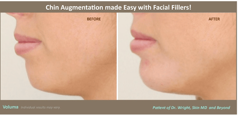 Before and after chin contouring Voluma TX